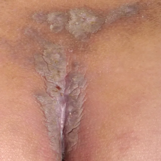 Zmiany skórne między pośladkami liszaj płaski
