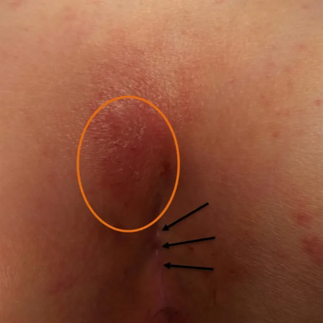 Zmiany skórne między pośladkami