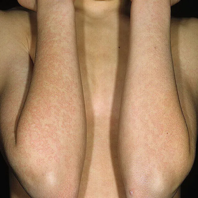 Zmiany skórne na łokciach 