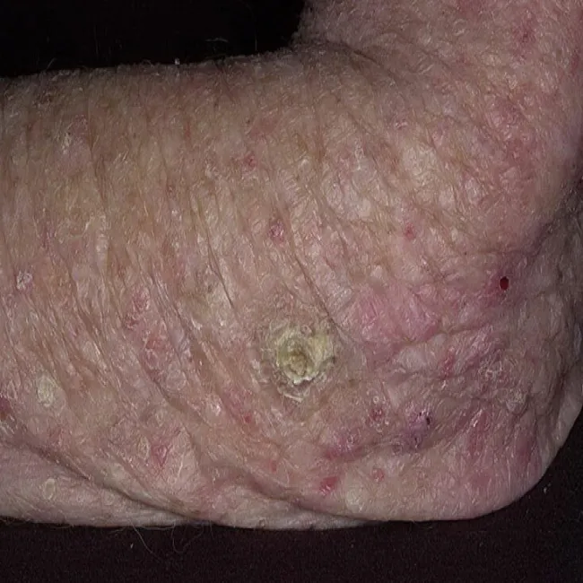 Zmiany skórne na łokciu rogowacenie słoneczne