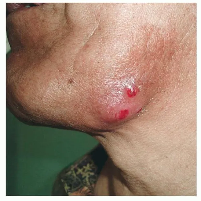 Zmiany skórne na brodzie choroba promienica