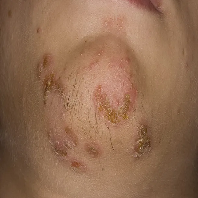 Zmiany skórne na brodzie liszajec