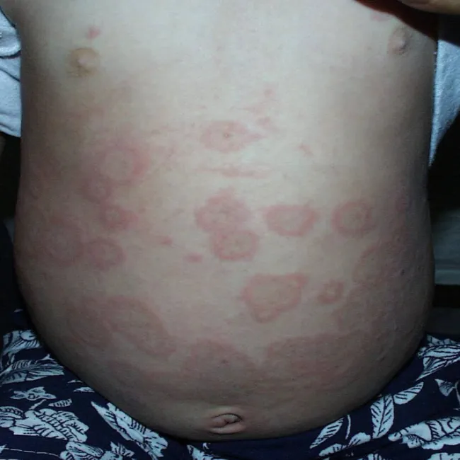 Zmiany skórne na brzuchu u dziecka 
