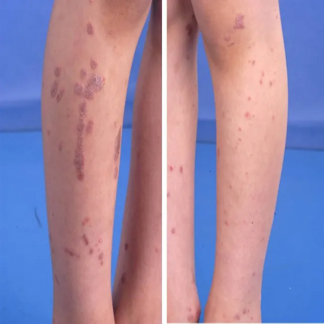 Zmiany skórne na nogach liszaj płaski