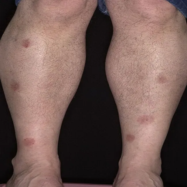 Zmiany skórne na nogach zdjęcia wyprysk pieniążkowaty