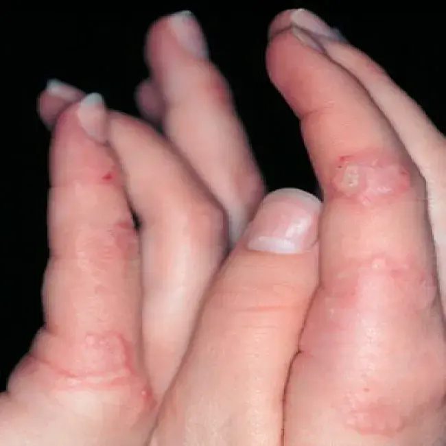 Zmiany skórne na palcach dłoni ziarniniak obrączkowaty 