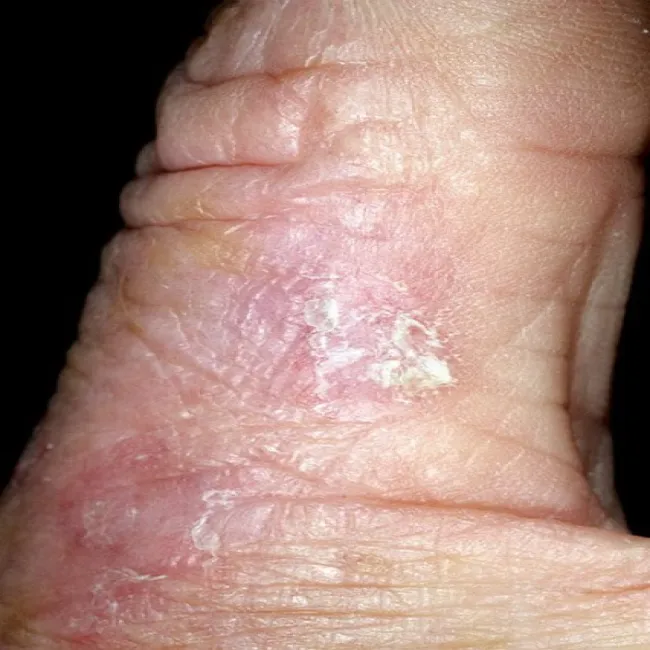 Zmiany skórne na palcu choroba rogowacenie