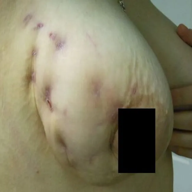 Zmiany skórne na piersi choroba promienica