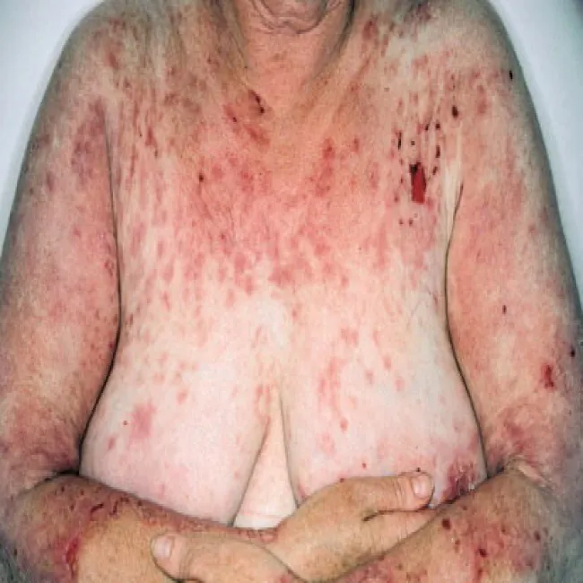 Zmiany skórne na piersiach zdjęcia pęcherzyca zwykła