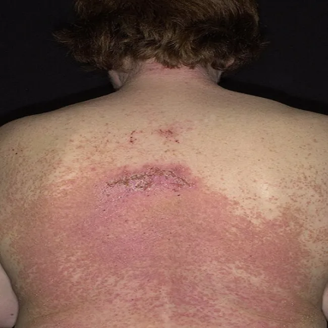 Zmiany skórne na plecach choroba Dariera