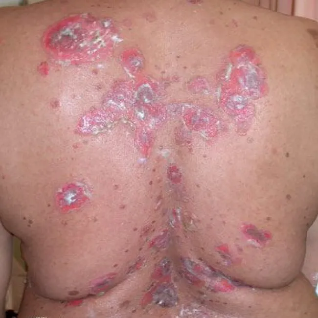 Zmiany skórne na plecach zdjęcia pęcherzyca zwykła