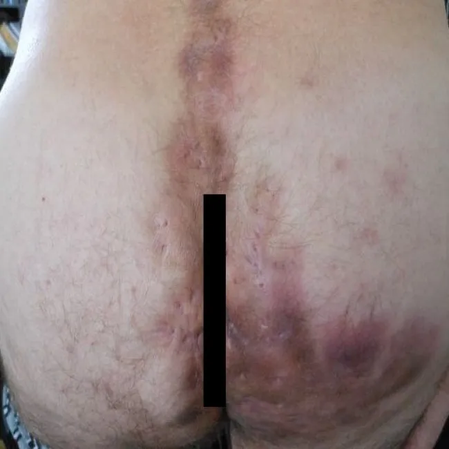 Zmiany skórne na pośladkach choroba promienica