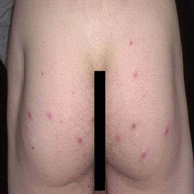 Zmiany skórne na pośladkach zapalenie mieszków włosowych