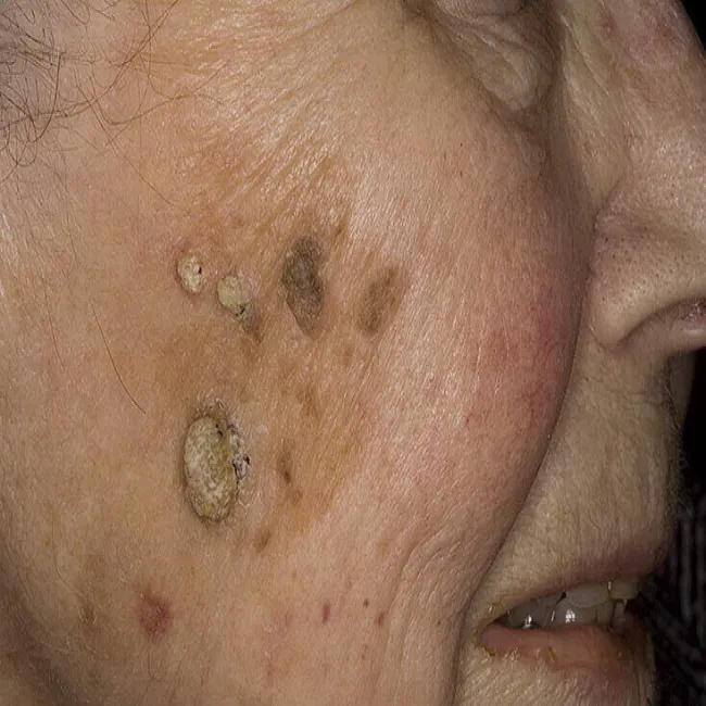 Zmiany skórne na poliku brodawka łojotokowa