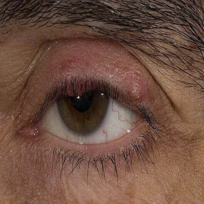 Zmiany skórne na powiekach zapalenie mieszków włosowych