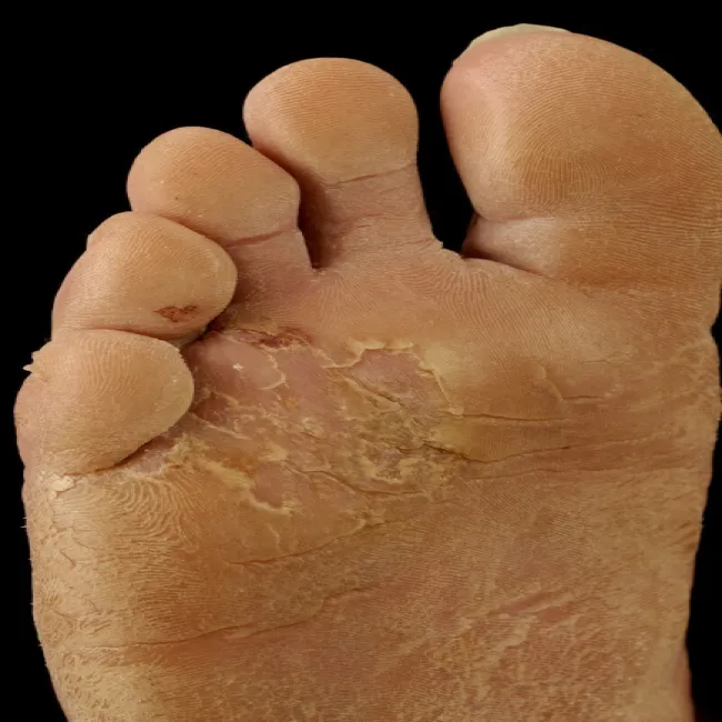 Zmiany skórne na stopach hiperkeratoza