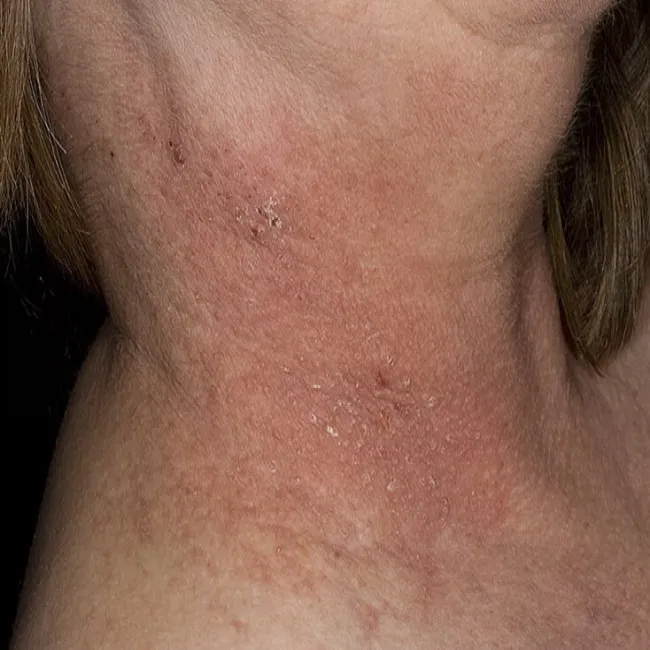 Zmiany skórne na szyi choroba Dariera