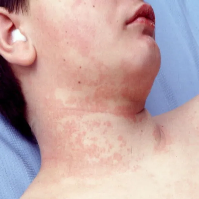 Zmiany skórne na szyi choroba Kawasakiego 