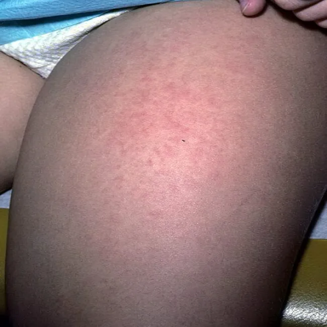 Zmiany skórne na udach u dziecka rumień zakaźny