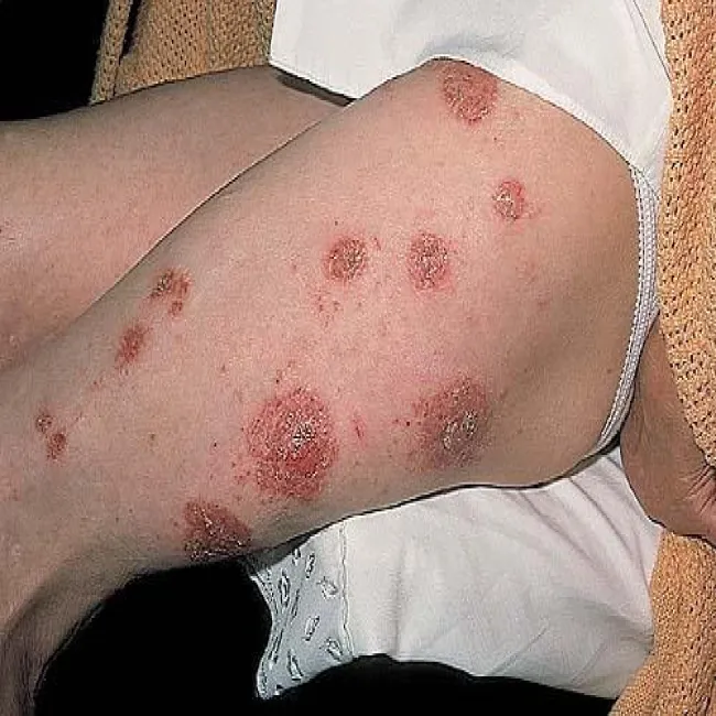 Zmiany skórne na udach wyprysk pieniążkowaty