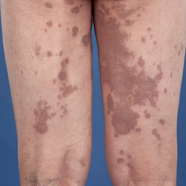 Zmiany skórne na udach ziarniniak obrączkowaty 