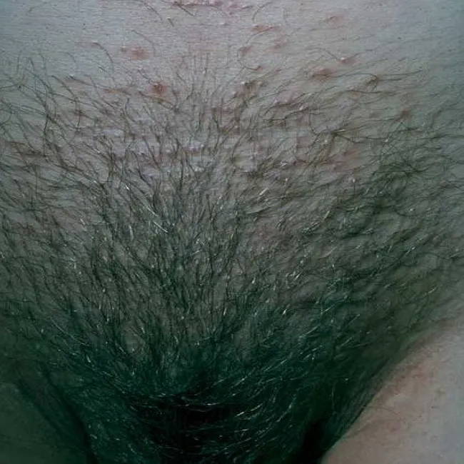 Zmiany skórne okolic intymnych choroba Foxa-Fordyce'a