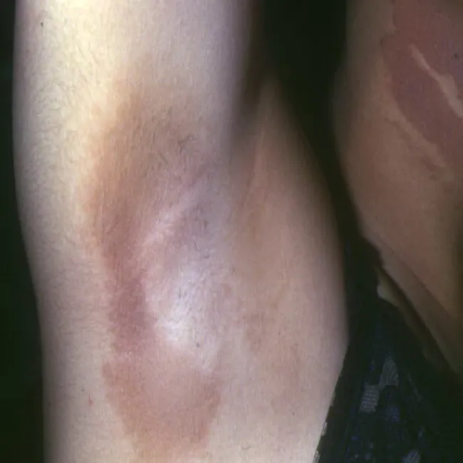 Zmiany skórne pod pachami rogowacenie ciemne