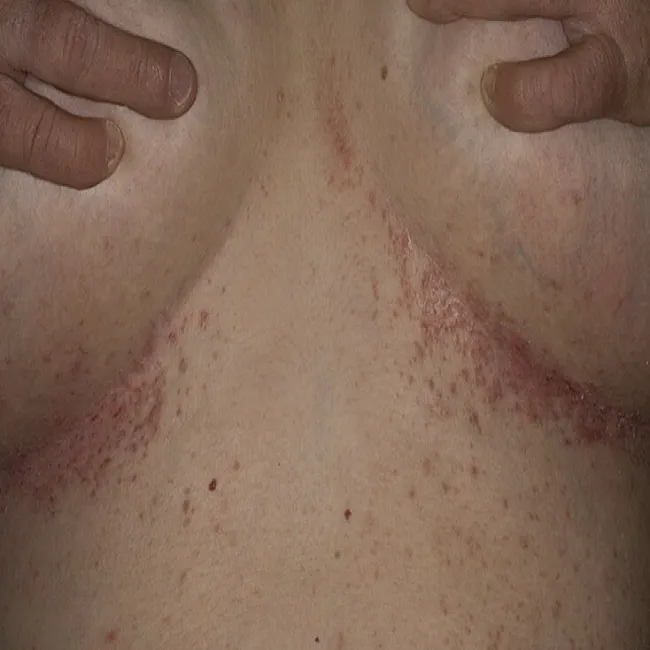 Zmiany skórne pod piersiami choroba Dariera