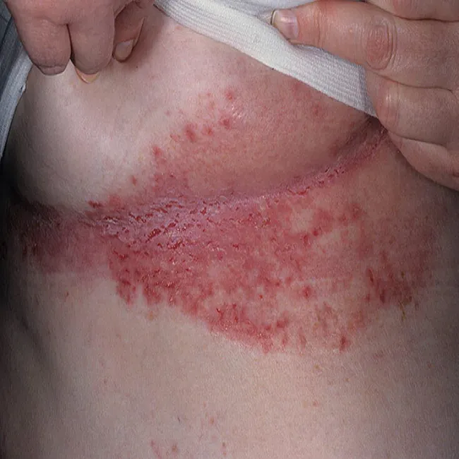 Zmiany skórne pod piersiami zdjęcia choroba Haileya-Haileya