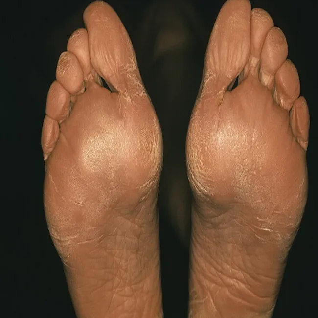 Zmiany skórne stóp rogowacenie