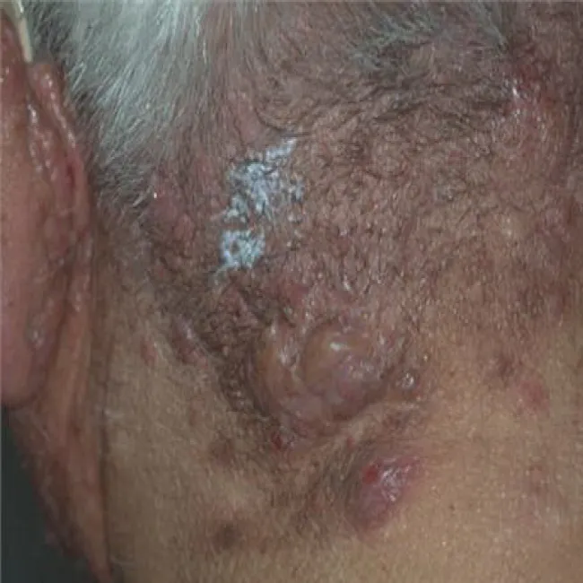 Zmiany skórne trądzik skupiony 