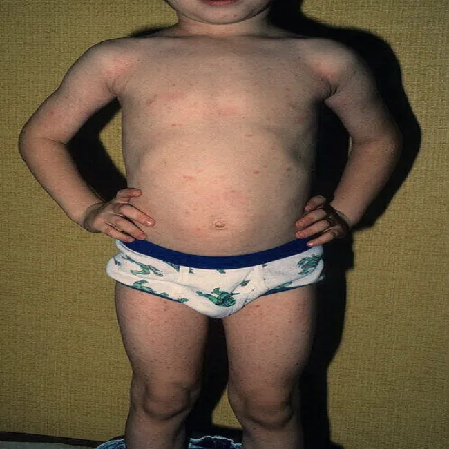 Zmiany skórne u dzieci przyłuszczyca