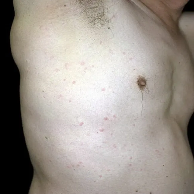 Zmiany skórne u sportowców pokrzywka cholinergiczna 