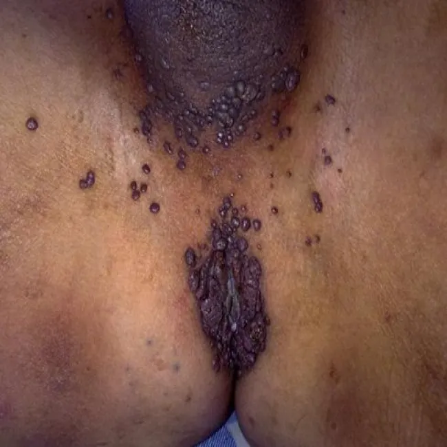 Zmiany skórne w okolicy odbytu grudkowatość bowenoidalna 