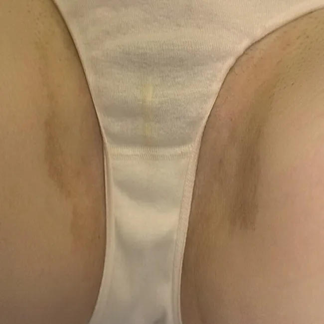 Zmiany skórne w pachwinie u kobiet łupież rumieniowy 