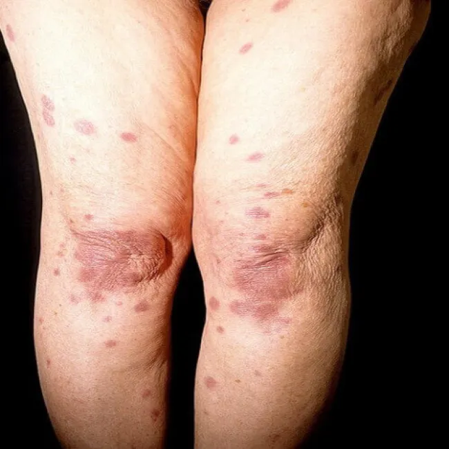 Zmiany skórne w zespole Sweeta na nogach