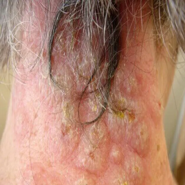 Zmiany skórne w zespole Sweeta na szyi