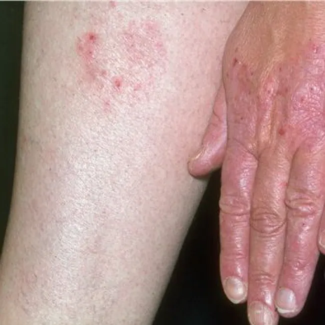 Zmiany skórne wyprysk pieniążkowaty 