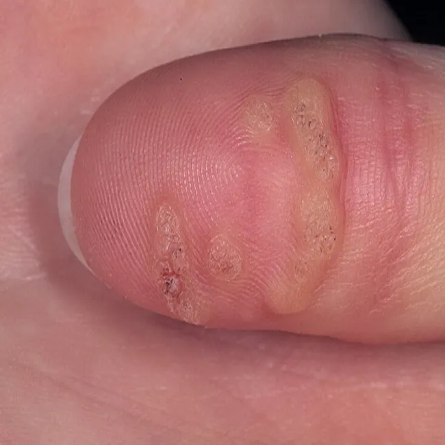 Zmiany skórne zdjęcia na palcu kurzajki