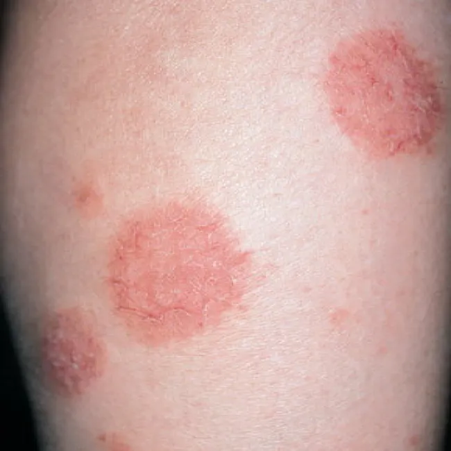 Zmiany skórne zdjęcia wyprysk pieniążkowaty