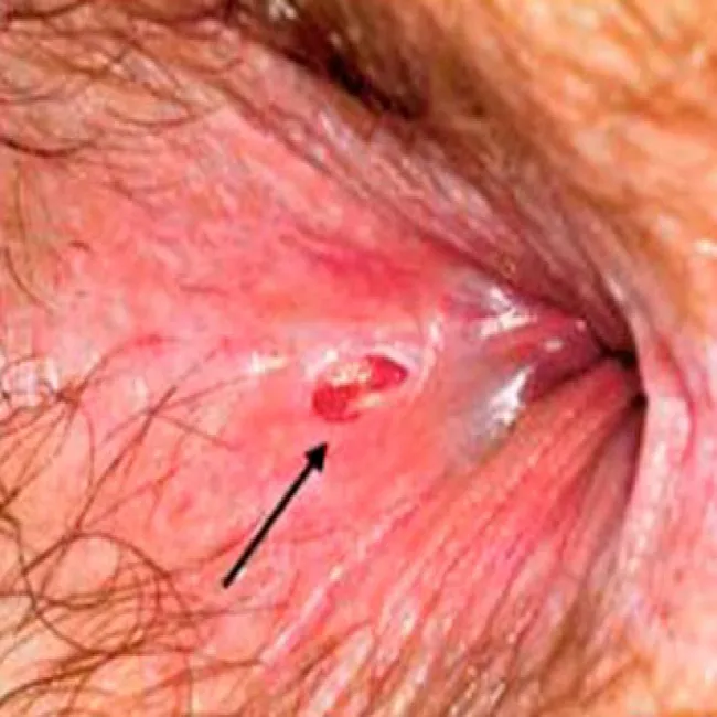 Zmiany w okolicy odbytu szczelina odbytu 