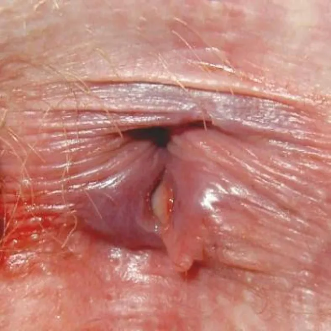 Zmiany w okolicy odbytu zdjęcia 