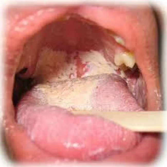Zmiany w jamie ustnej biały nalot