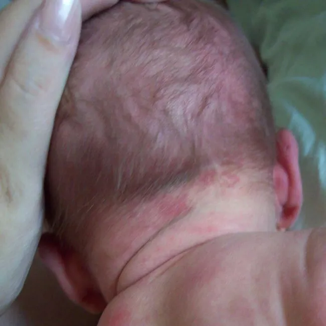 Znamię na szyi znak bociana