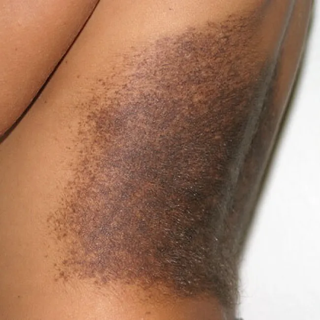 Znamiona barwnikowe na skórze