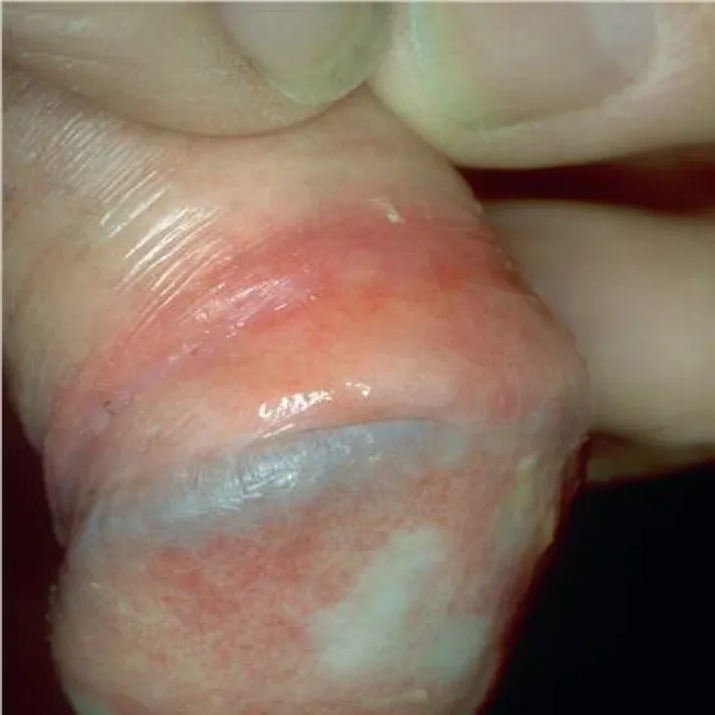 Zoon's vulvitis