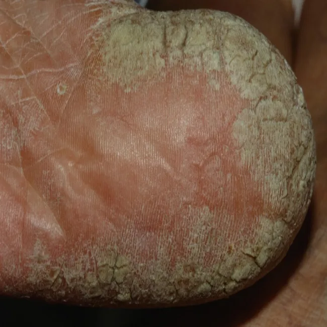 Zrogowacenia na stopach