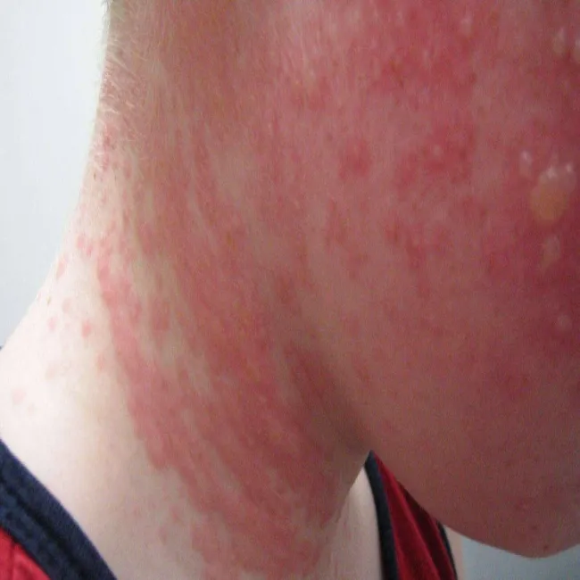 Alergia na słońce u dziecka na twarzy