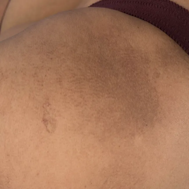 amyloidozy skóry na nodze