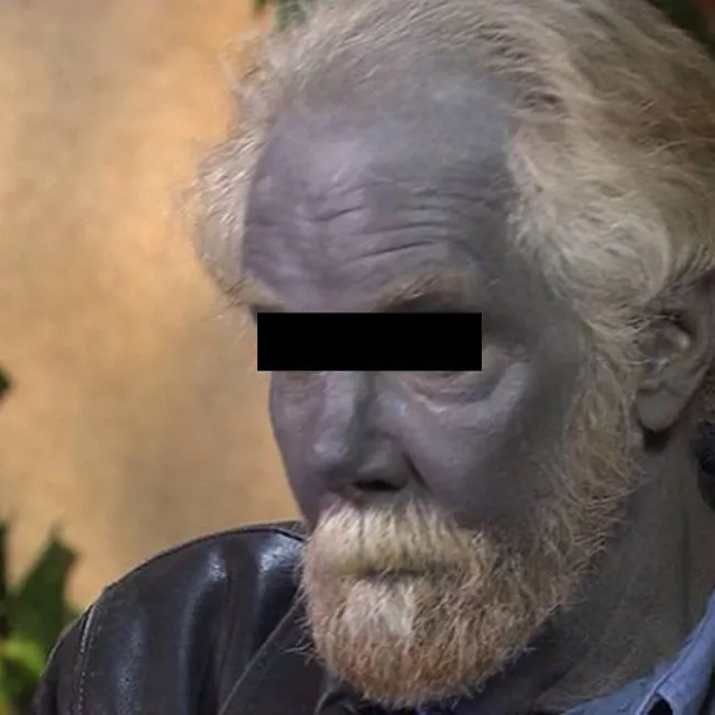 argyria 